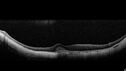 myopicCNVM1_861016_02132023_10.jpg