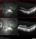 myopicCNVM1_861016_02132023_12.jpg