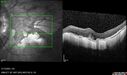 myopicCNVM1_861016_02132023_23.jpg