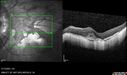 myopicCNVM1_861016_02132023_24.jpg