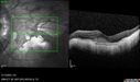 myopicCNVM1_861016_02132023_26.jpg