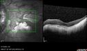 myopicCNVM1_861016_02132023_28.jpg