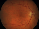nasal-brao_inmur_031618_01.png