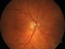 nasal-brao_inmur_031618_02.png