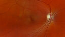 Filename=opticneuritis_124345_031725_01.jpg
Filesize=992KiB
Dimensions=1870x1053
Date added=Jul 28, 2025 opticneuritis_124345_031725_01.jpg