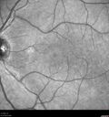 Filename=opticneuritis_124345_031725_04.jpg
Filesize=1054KiB
Dimensions=1536x1636
Date added=Jul 28, 2025 opticneuritis_124345_031725_04.jpg
