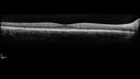Filename=opticneuritis_124345_031725_07.jpg
Filesize=533KiB
Dimensions=1536x864
Date added=Jul 28, 2025 opticneuritis_124345_031725_07.jpg