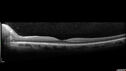 papilledema_dafer_010719_10.jpg