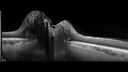 papilledema_dafer_010719_11.jpg