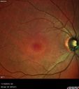 plaquenil_4yr_chfra_111819_03.jpg