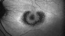plaquenil_elmcc1_052421_04.jpg