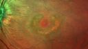 plaquenil_elmcc1_052421_06.jpg