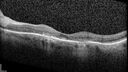 plaquenil_elmcc1_052421_09.jpg