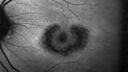 plaquenil_elmcc2_020322_12.jpg