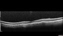plaquenil_elmcc2_020322_13.jpg