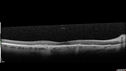 plaquenil_elmcc2_020322_14.jpg