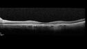 plaquenil_elmcc2_020322_16.jpg