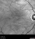 reticular-drusen_119305_052424_03.jpg