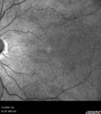 reticular-drusen_119305_052424_04.jpg