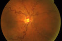 retinalvasctortuosity_28229.jpg