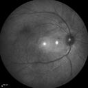 retinalvasculitis_chcs_071913_05.jpg