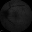 retinalvasculitis_chcs_071913_08.jpg