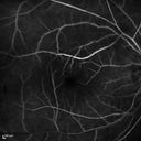 retinalvasculitis_chcs_071913_09.jpg