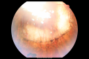 retinoblastomaregressedjaei_281329.png