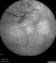 retinoschisis-st-mysh-010214_000.jpg