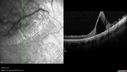 retinoschisis-st-mysh-010214_002.jpg