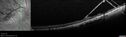 retinoschisis-st-mysh-100217-.jpg