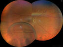 Filename=retinoschisis_01.jpg
Filesize=2230KiB
Dimensions=6624x4972
Date added=Dec 17, 2025 retinoschisis_01.jpg