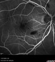 rothspot-anemia_117768_112123_05.jpg