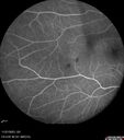 Filename=rothspot-anemia_117768_112123_09.jpg
Filesize=92KiB
Dimensions=768x868
Date added=Aug 13, 2025 rothspot-anemia_117768_112123_09.jpg
