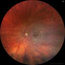 wetAMD-Classic_becos_082420__03.jpg