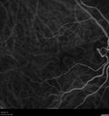 wetAMD-Classic_becos_082420__19.jpg