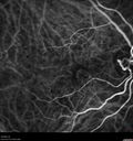 wetAMD-Classic_becos_082420__20.jpg