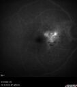wetAMD_gamus_061422_26.jpg