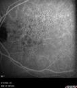 wetAMD_gamus_061422_45.jpg