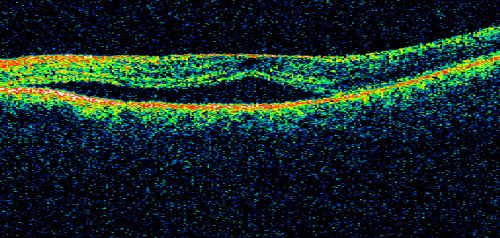 Chronic Central Serous Retinopathy - Gutter in Both Eyes - Treated with PDT - Visudyne
69-year-old man with blurred vision in the right eye for about three weeks.  He had a similar episode about twenty years ago which lasted about six weeks.  He is not taking any steroids.  He takes Lupron injections for his prostate cancer every three months. 

VISUAL ACUITY:  Vision OD is 20/80
FU: Treated with PDT after 6 months of observation with success.  Treatment was done to area between nerve and fovea at 1/2 fluence.
Keywords: csr;visudyne;chronic;gutter;serous