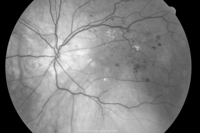 Diabetic Macular Edema with Circinate Exudate Red Free
74-year-old man has diabetic macular edema in both eyes and background diabetic retinopathy.  His vision has blurred over the last few months.  His blood sugars have been fluctuating.

VISUAL ACUITY: Vision OD is 20/25, OS is 20/80
