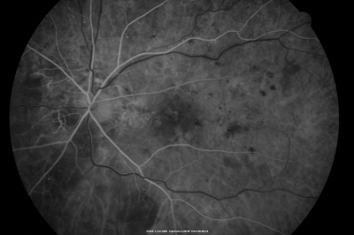 Diabetic Macular Edema with Circinate Exudate Early FA
74-year-old man has diabetic macular edema in both eyes and background diabetic retinopathy.  His vision has blurred over the last few months.  His blood sugars have been fluctuating.

VISUAL ACUITY: Vision OD is 20/25, OS is 20/80
