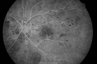 Diabetic Macular Edema with Circinate Exudate Early FA
74-year-old man has diabetic macular edema in both eyes and background diabetic retinopathy.  His vision has blurred over the last few months.  His blood sugars have been fluctuating.

VISUAL ACUITY: Vision OD is 20/25, OS is 20/80
