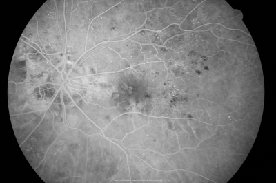 Diabetic Macular Edema with Circinate Exudate 
74-year-old man has diabetic macular edema in both eyes and background diabetic retinopathy.  His vision has blurred over the last few months.  His blood sugars have been fluctuating.

VISUAL ACUITY: Vision OD is 20/25, OS is 20/80
