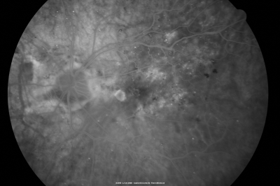 Diabetic Macular Edema with Circinate Exudate 
74-year-old man has diabetic macular edema in both eyes and background diabetic retinopathy.  His vision has blurred over the last few months.  His blood sugars have been fluctuating.

VISUAL ACUITY: Vision OD is 20/25, OS is 20/80
