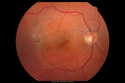 Old Branch Retinal Vein Occlusion- Severe CME - Pucker - Diabetic Fundus Photo
61-year old man has diabetic retinopathy in the right eye.   He also had a macular pucker and macular edema.   I did a vitrectomy on September 5th.   His vision was initially improving.   His vision in the right eye seems to be a little more foggy.  

VISUAL ACUITY:   OD:  20/200
Keywords: severe CME; pucker; BRVO; Diabetic