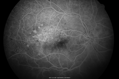 Old Branch Retinal Vein Occlusion- Severe CME - Pucker - Diabetic Early FA
61-year old man has diabetic retinopathy in the right eye.   He also had a macular pucker and macular edema.   I did a vitrectomy on September 5th.   His vision was initially improving.   His vision in the right eye seems to be a little more foggy.  

VISUAL ACUITY:   OD:  20/200
Keywords: severe CME; pucker; BRVO; Diabetic