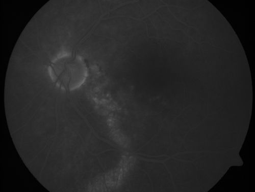 Chronic Central Serous Retinopathy - Gutter in Both Eyes - Treated with PDT - Visudyne
69-year-old man with blurred vision in the right eye for about three weeks.  He had a similar episode about twenty years ago which lasted about six weeks.  He is not taking any steroids.  He takes Lupron injections for his prostate cancer every three months. 

VISUAL ACUITY:  Vision OD is 20/80
FU: Treated with PDT after 6 months of observation with success.  Treatment was done to area between nerve and fovea at 1/2 fluence.
Keywords: csr;visudyne;chronic;gutter;serous