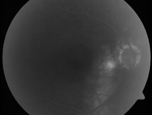 Chronic Central Serous Retinopathy - Gutter in Both Eyes - Treated with PDT - Visudyne
69-year-old man with blurred vision in the right eye for about three weeks.  He had a similar episode about twenty years ago which lasted about six weeks.  He is not taking any steroids.  He takes Lupron injections for his prostate cancer every three months. 

VISUAL ACUITY:  Vision OD is 20/80
FU: Treated with PDT after 6 months of observation with success.  Treatment was done to area between nerve and fovea at 1/2 fluence.
Keywords: csr;visudyne;chronic;gutter;serous