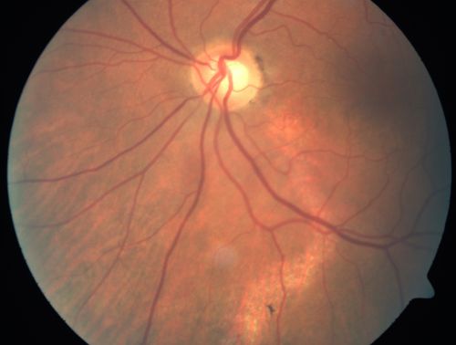 Chronic Central Serous Retinopathy - Gutter in Both Eyes - Treated with PDT - Visudyne
69-year-old man with blurred vision in the right eye for about three weeks.  He had a similar episode about twenty years ago which lasted about six weeks.  He is not taking any steroids.  He takes Lupron injections for his prostate cancer every three months. 

VISUAL ACUITY:  Vision OD is 20/80
FU: Treated with PDT after 6 months of observation with success.  Treatment was done to area between nerve and fovea at 1/2 fluence.
Keywords: csr;visudyne;chronic;gutter;serous